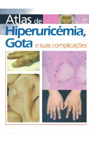Atlas de Hiperuricémia, Gota e suas Complicações